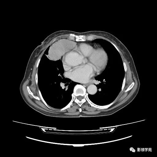 胸腺小細胞癌1例ct
