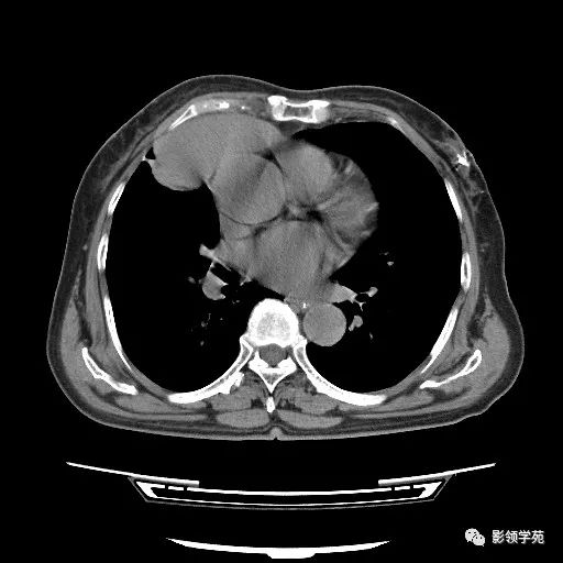 胸腺小細胞癌1例ct