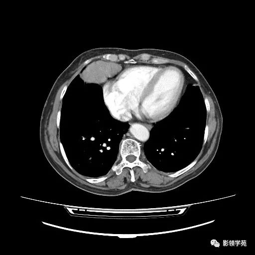 胸腺小細胞癌1例ct