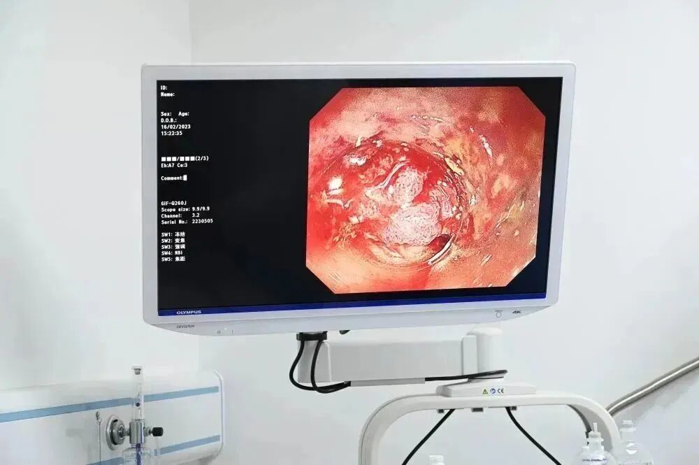 奥林巴斯胃肠镜怎么做全球最先进胃肠镜奥林巴斯290入驻我院！_https://www.jmylbn.com_新闻资讯_第6张