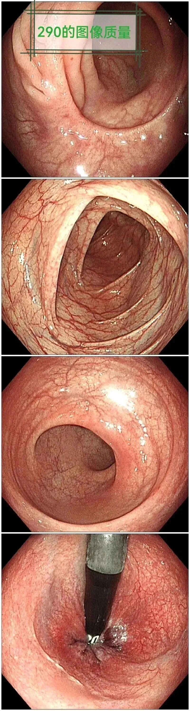奥林巴斯胃肠镜怎么做全球最先进胃肠镜奥林巴斯290入驻我院！_https://www.jmylbn.com_新闻资讯_第8张