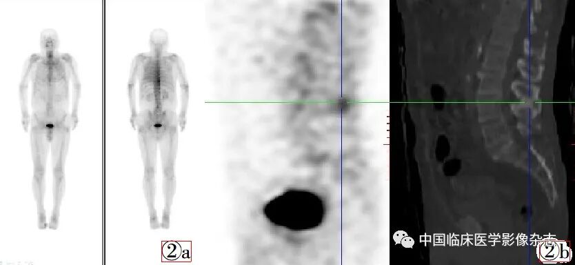 d-spect怎么检查Baastrup病99mTc-MDP SPECT／CT全身骨显像2例_https://www.jmylbn.com_新闻资讯_第2张