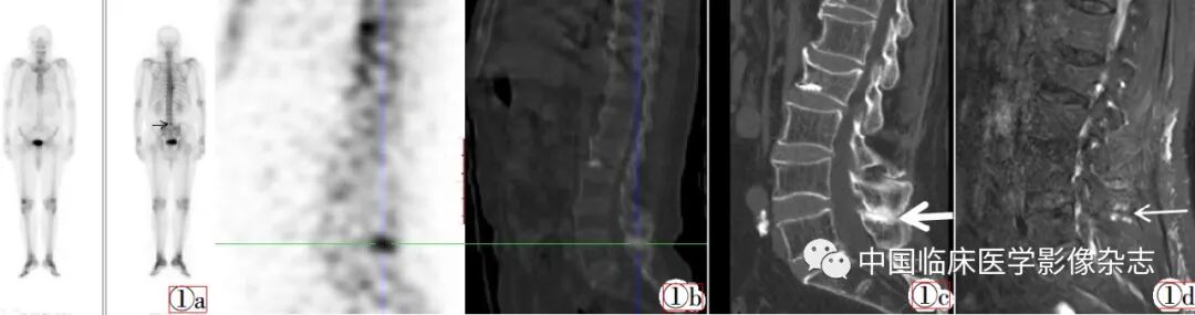 d-spect怎么检查Baastrup病99mTc-MDP SPECT／CT全身骨显像2例_https://www.jmylbn.com_新闻资讯_第1张