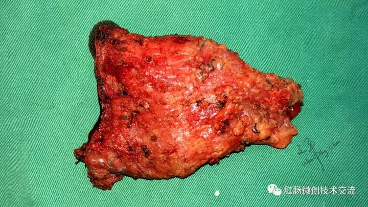 为什么手术用电刀【手术笔记】全电刀Altemeier术体会_https://www.jmylbn.com_新闻资讯_第21张