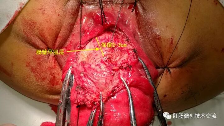 为什么手术用电刀【手术笔记】全电刀Altemeier术体会_https://www.jmylbn.com_新闻资讯_第6张