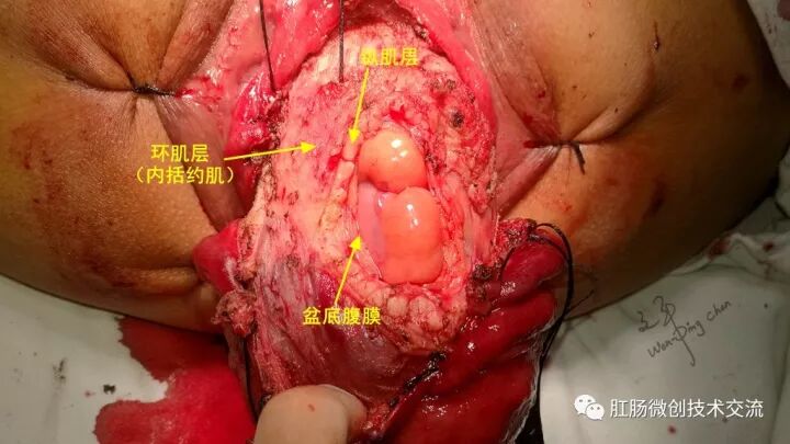 为什么手术用电刀【手术笔记】全电刀Altemeier术体会_https://www.jmylbn.com_新闻资讯_第9张