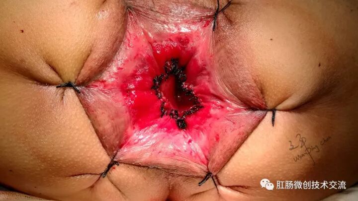 为什么手术用电刀【手术笔记】全电刀Altemeier术体会_https://www.jmylbn.com_新闻资讯_第19张