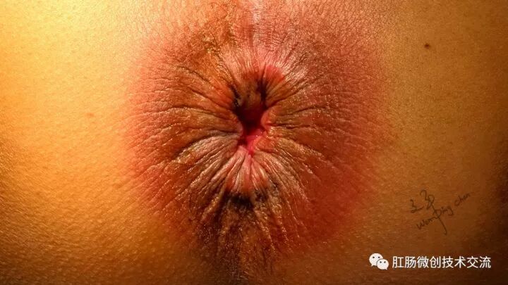 为什么手术用电刀【手术笔记】全电刀Altemeier术体会_https://www.jmylbn.com_新闻资讯_第1张