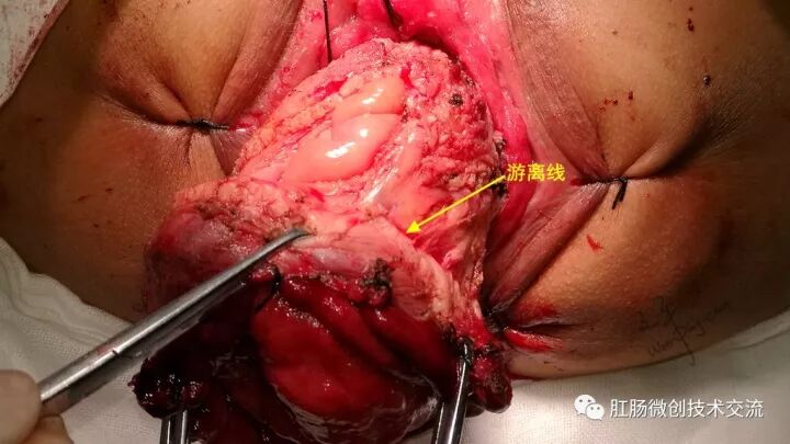 为什么手术用电刀【手术笔记】全电刀Altemeier术体会_https://www.jmylbn.com_新闻资讯_第11张