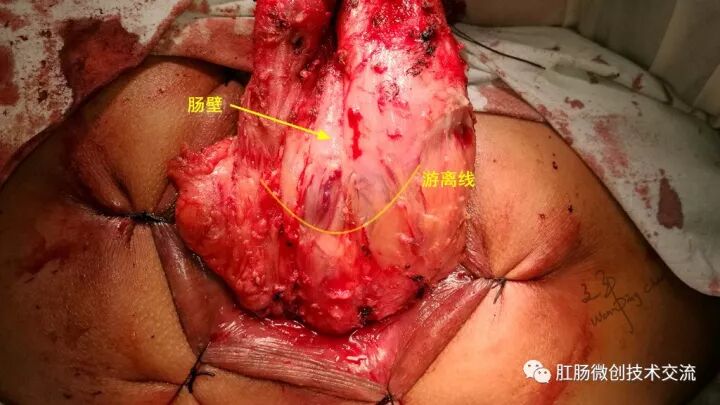 为什么手术用电刀【手术笔记】全电刀Altemeier术体会_https://www.jmylbn.com_新闻资讯_第14张