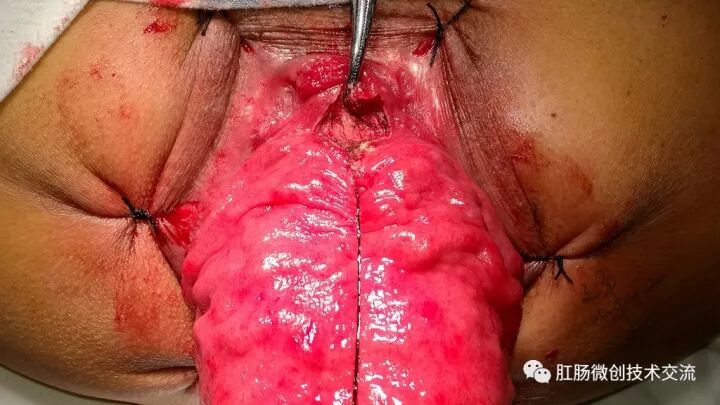 为什么手术用电刀【手术笔记】全电刀Altemeier术体会_https://www.jmylbn.com_新闻资讯_第5张