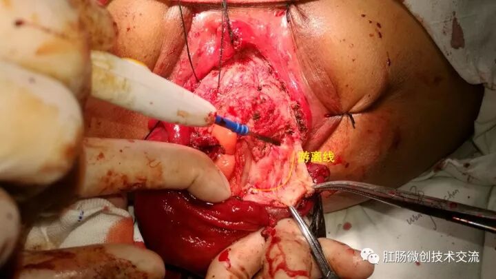 为什么手术用电刀【手术笔记】全电刀Altemeier术体会_https://www.jmylbn.com_新闻资讯_第8张