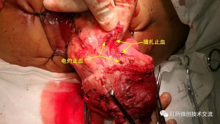 为什么手术用电刀【手术笔记】全电刀Altemeier术体会_https://www.jmylbn.com_新闻资讯_第13张