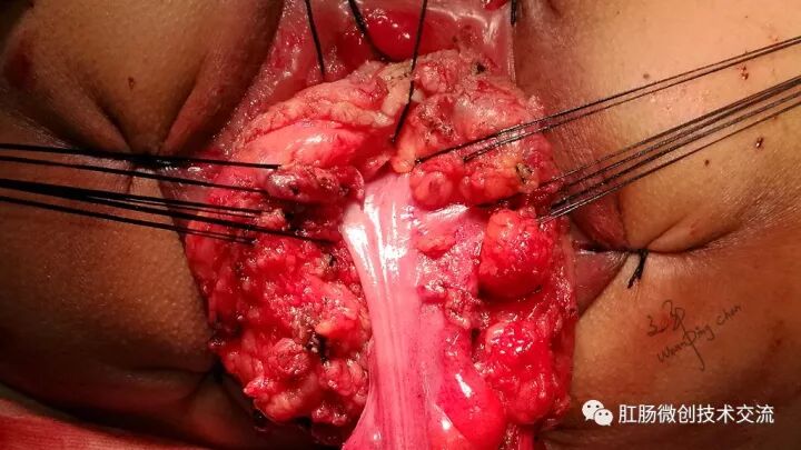 为什么手术用电刀【手术笔记】全电刀Altemeier术体会_https://www.jmylbn.com_新闻资讯_第15张