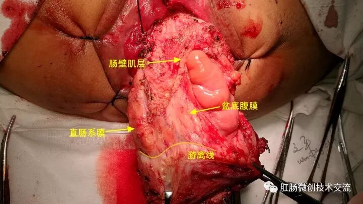 为什么手术用电刀【手术笔记】全电刀Altemeier术体会_https://www.jmylbn.com_新闻资讯_第12张