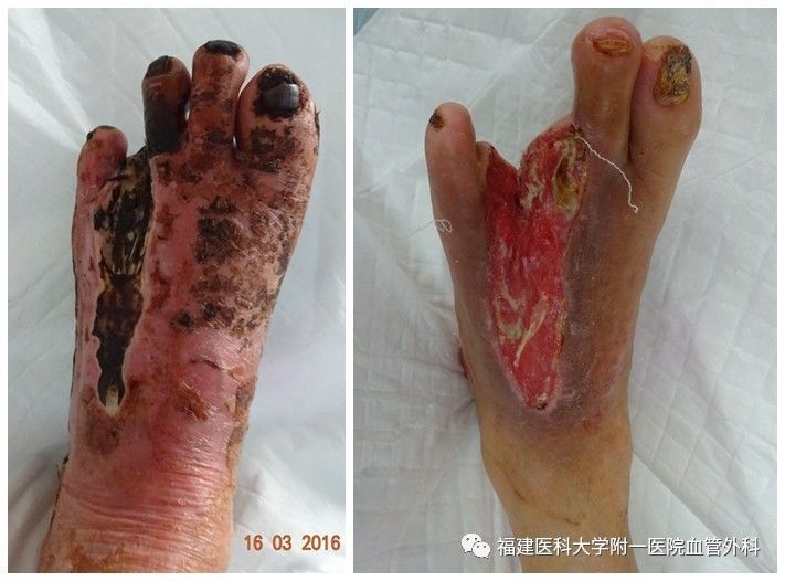 闭塞症,在治疗上予以止痛,抗凝,消炎,改善循环,伤口给予药物浸泡处理