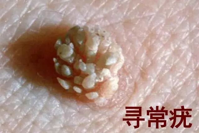 上皮组织良性增生,主要是各种疣,比如明显的生殖器疣以及不明显的宫颈