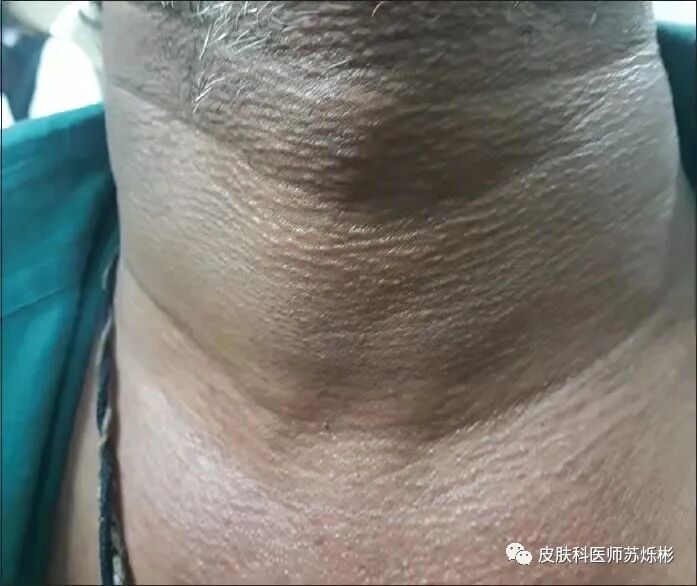 脖子上皮像鸡皮疙瘩(脖子上怎么会有鸡皮疙瘩)