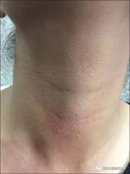 皮肤鸡皮疙瘩是湿疹吗(鸡皮疙瘩凸起是皮疹还是湿疹)