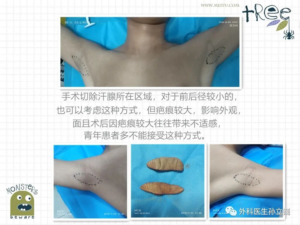 腋臭的手术治疗方案