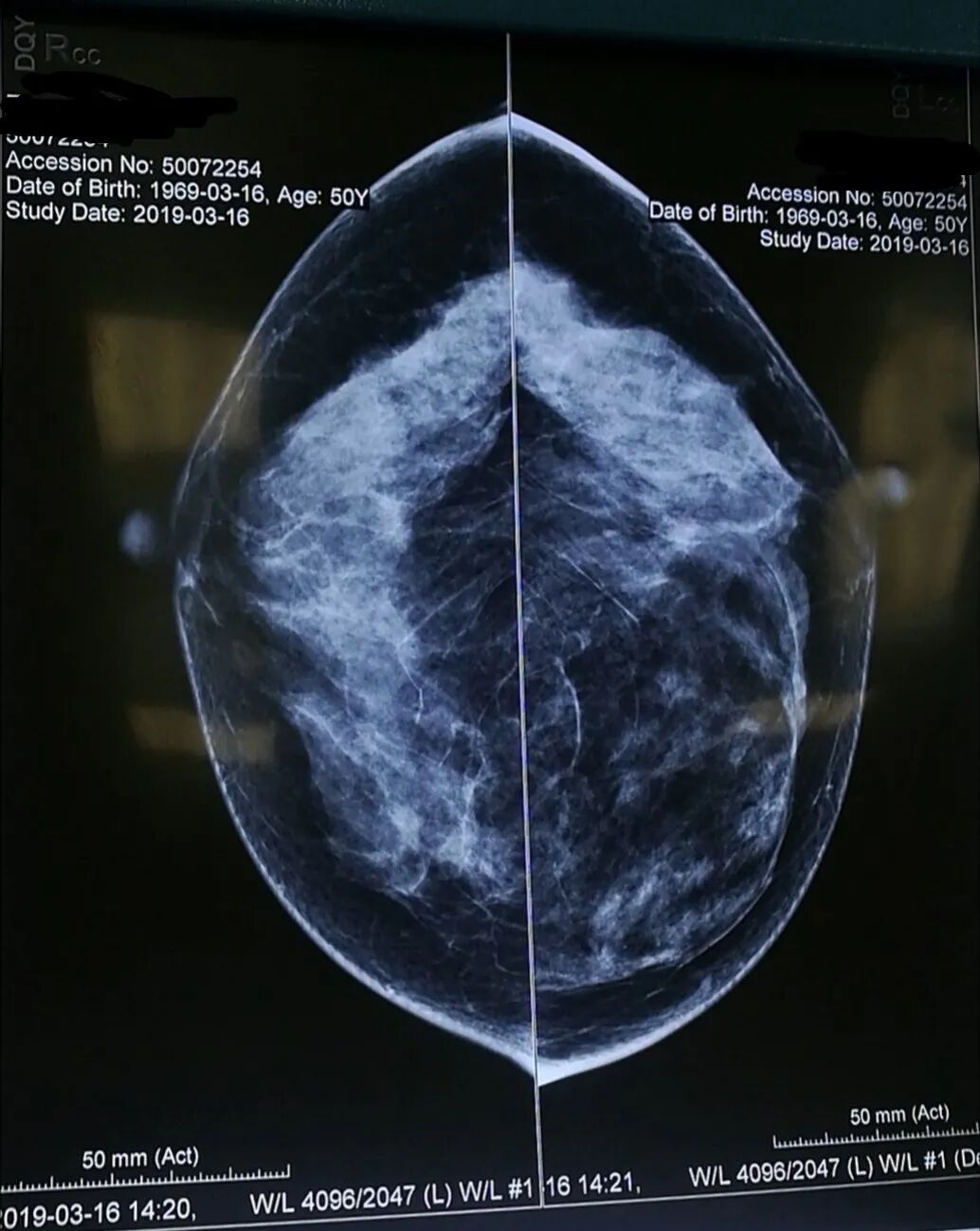 数字钼靶是什么乳腺病的照妖镜：数字化乳腺钼靶_https://www.jmylbn.com_新闻资讯_第8张