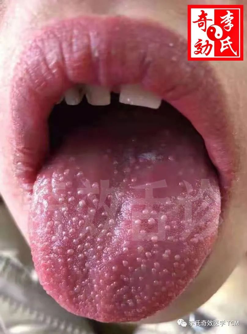 杨梅舌——经典舌象讲解【奇效舌诊】