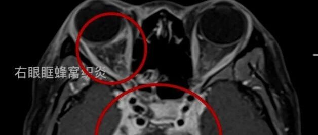 热搜第一！19岁女孩颅内感染，这个动作很多人都爱做...网友：原来我命真大