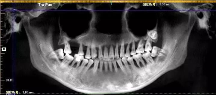 28歲姑娘一排牙都被醫生拔光！這個習慣害苦她 未分類 第3張