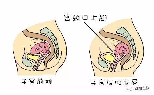 子宮位置會影響受孕 婦產醫生授你懷孕祕籍 醫知袋鼠 微文庫