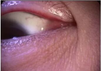 裂隙灯上光源是什么裂隙灯检查，查什么？？？_https://www.jmylbn.com_新闻资讯_第6张