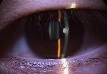 裂隙灯上光源是什么裂隙灯检查，查什么？？？_https://www.jmylbn.com_新闻资讯_第9张