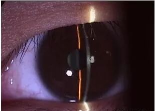 裂隙灯上光源是什么裂隙灯检查，查什么？？？_https://www.jmylbn.com_新闻资讯_第12张