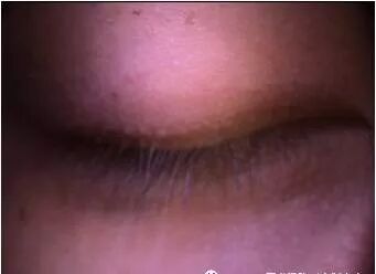 裂隙灯上光源是什么裂隙灯检查，查什么？？？_https://www.jmylbn.com_新闻资讯_第4张