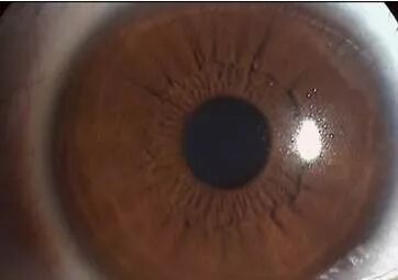 裂隙灯上光源是什么裂隙灯检查，查什么？？？_https://www.jmylbn.com_新闻资讯_第11张