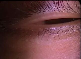 裂隙灯上光源是什么裂隙灯检查，查什么？？？_https://www.jmylbn.com_新闻资讯_第5张