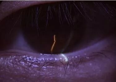 裂隙灯上光源是什么裂隙灯检查，查什么？？？_https://www.jmylbn.com_新闻资讯_第10张