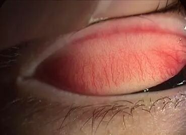 裂隙灯上光源是什么裂隙灯检查，查什么？？？_https://www.jmylbn.com_新闻资讯_第8张