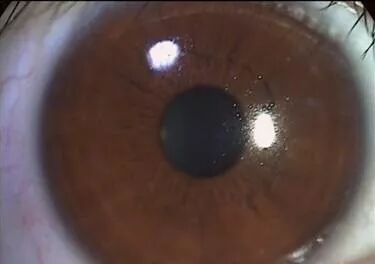 裂隙灯上光源是什么裂隙灯检查，查什么？？？_https://www.jmylbn.com_新闻资讯_第7张