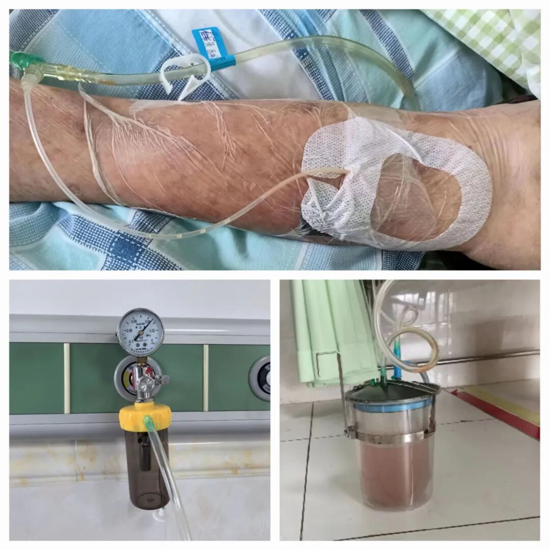 为什么负压引流负压封闭引流技术（VSD）护理慢性难愈创面_https://www.jmylbn.com_新闻资讯_第8张