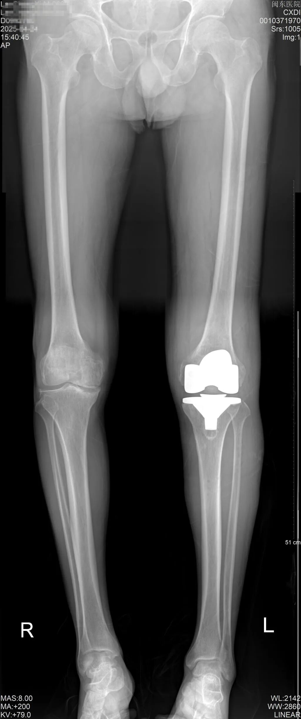 機(jī)器人輔助膝關(guān)節(jié)置換術(shù)后