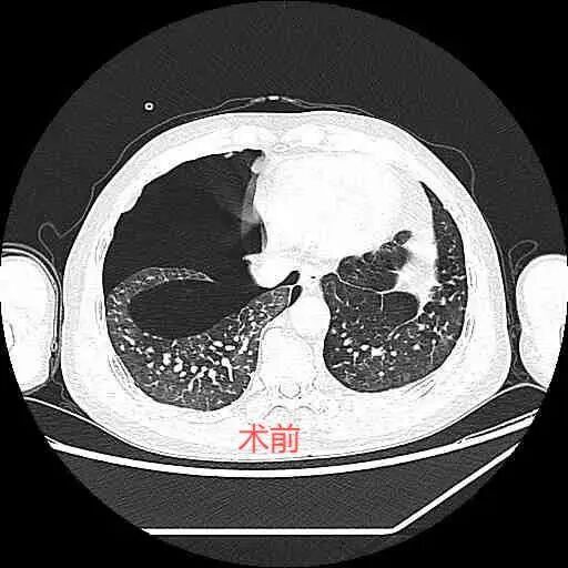 術(shù)前