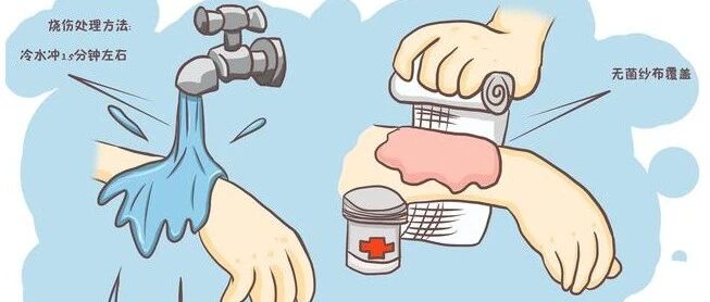 烫，烫，烫伤怎么办？