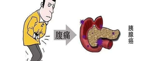 致命的“杀手”——胰腺癌