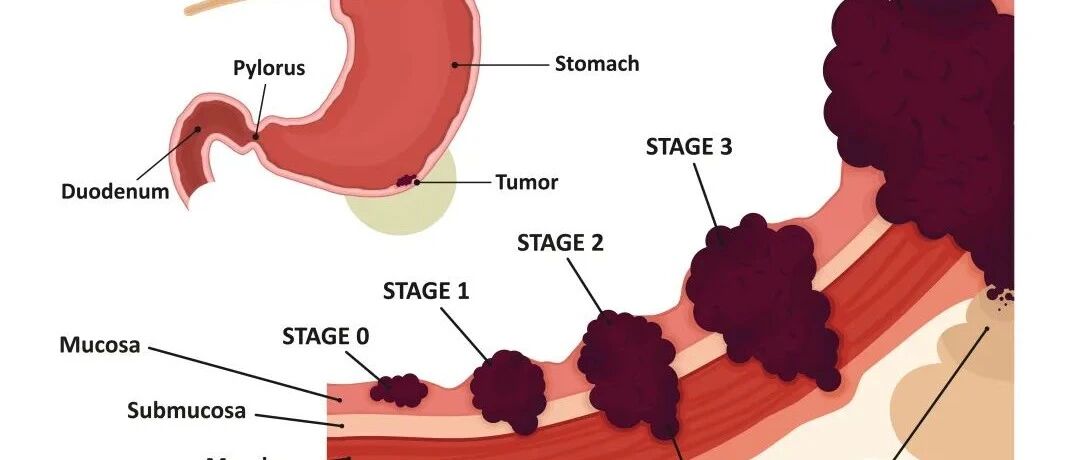 光分类就有十种！胃癌的类型竟然这么多！