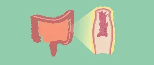 你知道溃疡性结肠炎的孪生兄弟是谁吗？