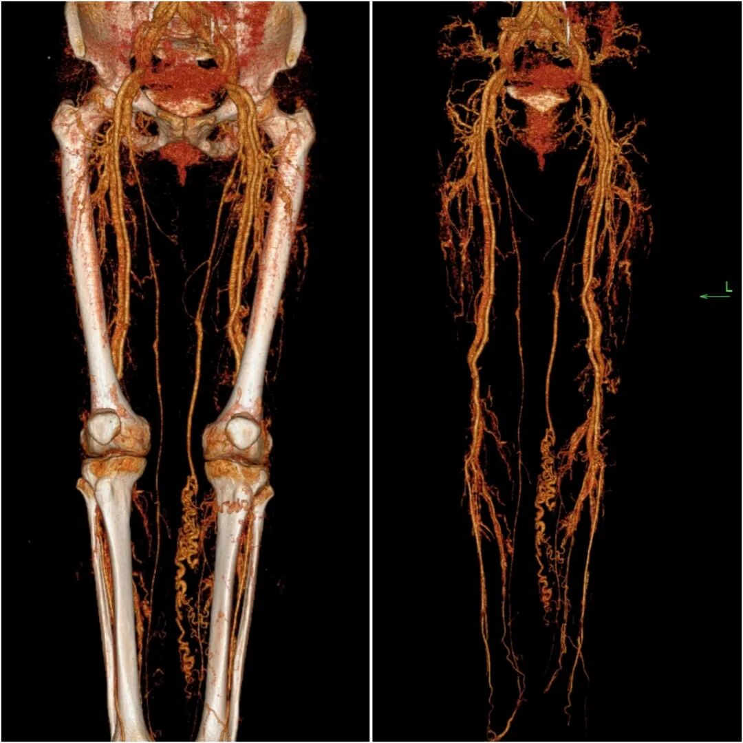 太行ct怎么样下肢静脉CTV技术，开启血管疾病诊断“高清模式”_https://www.jmylbn.com_新闻资讯_第6张