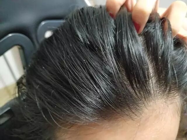 30万只螨虫在啃食你的头皮！难怪头油脱发、痒到抓狂