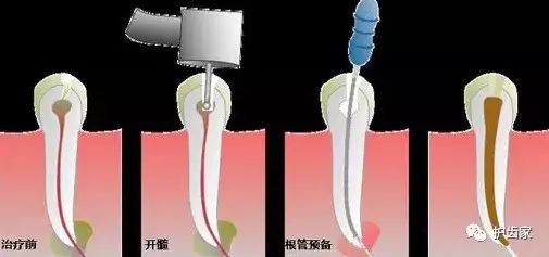 牙齦上長了個膿包，可以挑破嗎？ 健康 第2張