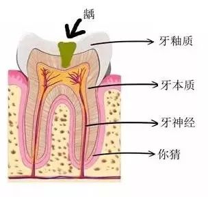 牙齒出現不痛不癢的小黑點時，及時治療才是省錢的開始！ 健康 第4張