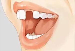 只缺一颗牙，不疼不影响吃饭，要不要去镶颗牙？